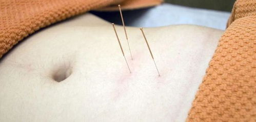 针灸治痛 十法 ,你学会了吗