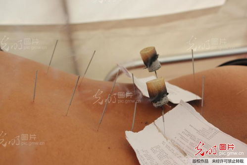 针灸推拿走进地芦山震灾区