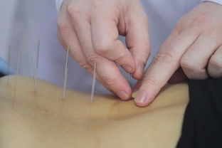 中医针灸有多神奇 这些成功案例传向世界