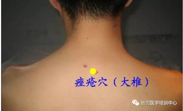 平衡针灸38个穴位图与文