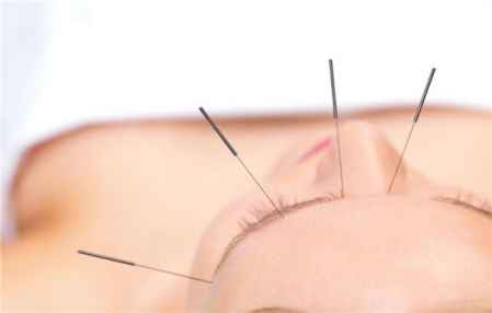 风湿性关节炎可以针灸吗 针灸治疗效果很好