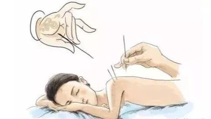 针灸急救--高热