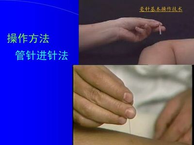 针灸基本操作手法