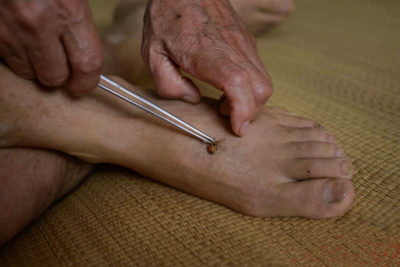 那些神奇的中医“民间”疗法