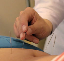 程氏针灸 传统医药 北京市级非遗项目