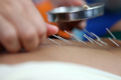 针灸针