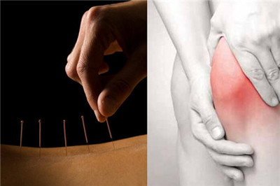 讲解针灸的好处与坏处 有效的调理气血