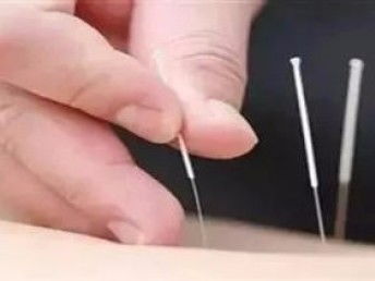 图 广州特色中医针灸培训 针灸美容学完推荐医院实习就业 广州职业培训