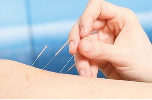 中医针灸减肥要先辩证再施针