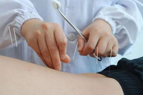 许柳田 针灸也可以治疗不孕症