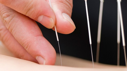 颈椎病针灸能治好吗