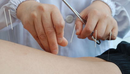 中风后康复 针灸显神威