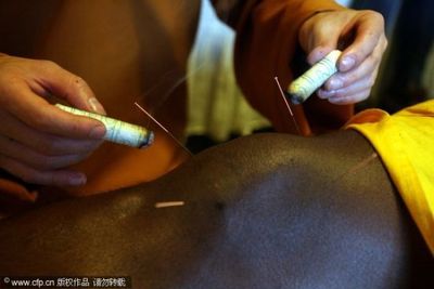 图文-少林禅医为皮特鲁斯根治顽疾 做针灸需要勇气