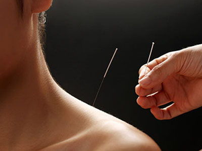 发现非遗之美 针灸