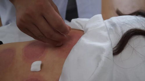 为什么针灸能够治疗失眠抑郁呢