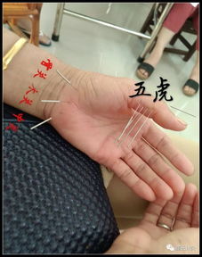 董氏针灸微课堂 十大处方之