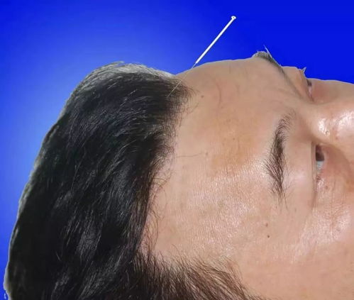 治病秘宝 史上最全针灸治病真图 珍藏版