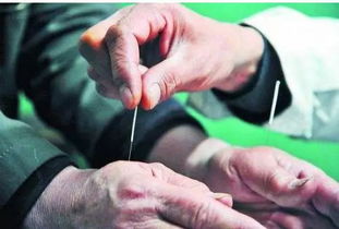快速掌握针灸补泻的手法及注意事项