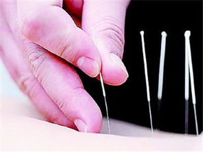 针灸的科学依据 传统医学与现代研究的交融