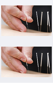 针刺疗法 传统医学的视觉探索