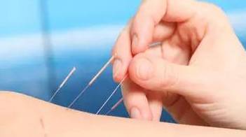 针灸 国之瑰宝，医之精髓