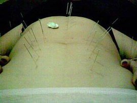 疑难杂症针灸验方精选